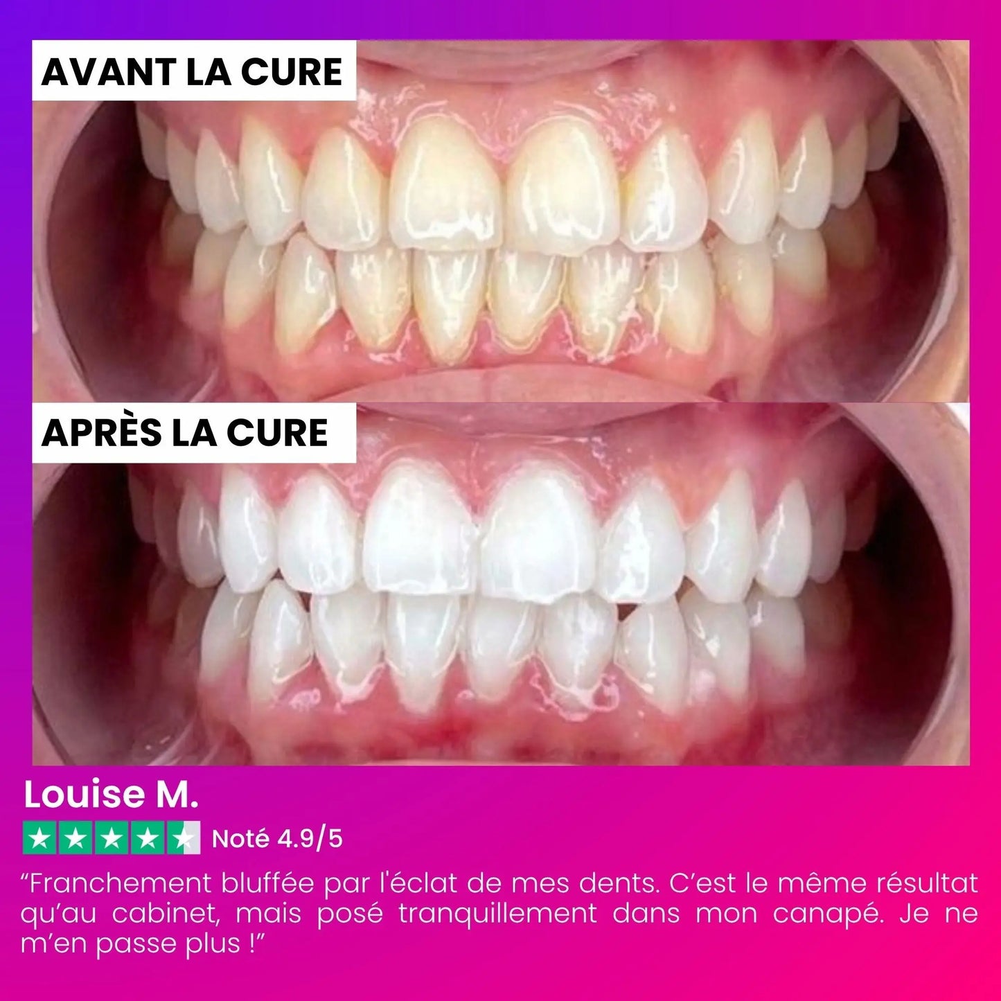 Kit de Blanchiment Dentaire LED IVI Smile