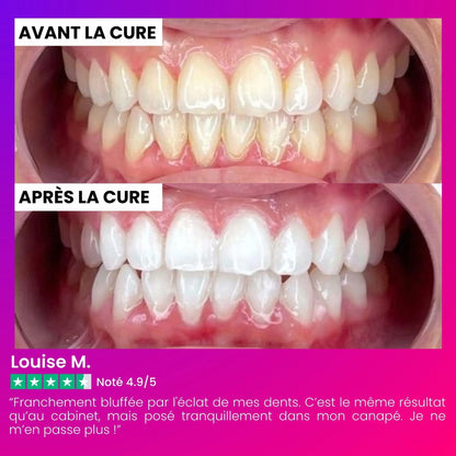 Kit de Blanchiment Dentaire LED IVI Smile